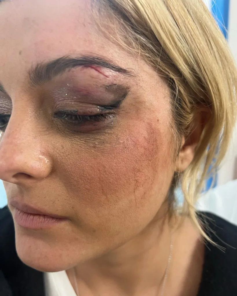 Bebe Rexha's bruised face/Instagram @beberexha